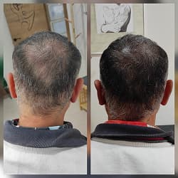 Tattoo micropigmentación